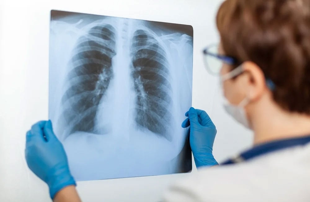 Рентген легких. Фото: Google