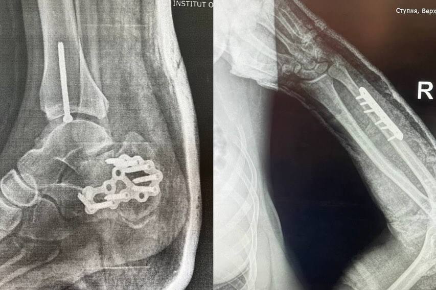 У прифронтовій зоні чоловік збив бійців "Айдару"