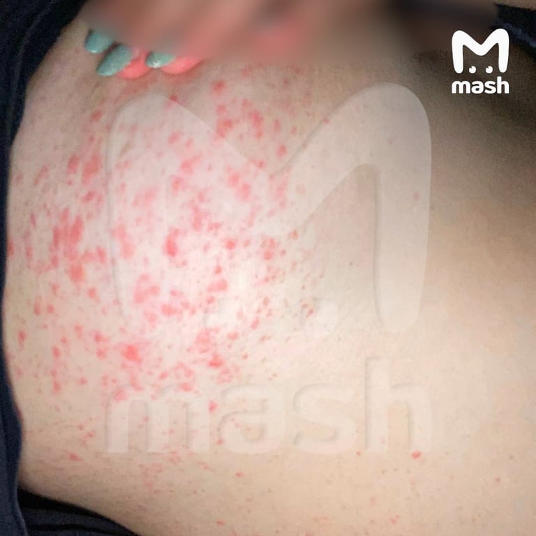 Шкіра дерматит