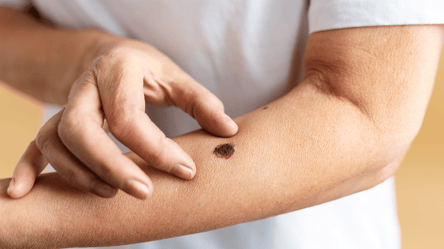 Родинки на теле — какое значение имеет каждая из них - 285x160