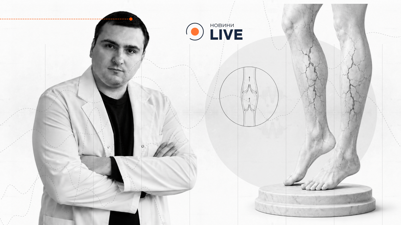 Варикоз на ногах опаснее, чем косметический дефект