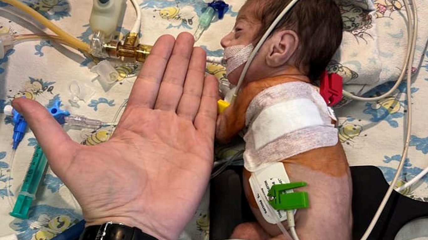 В Одессе сделали операцию малышам с пороками сердца