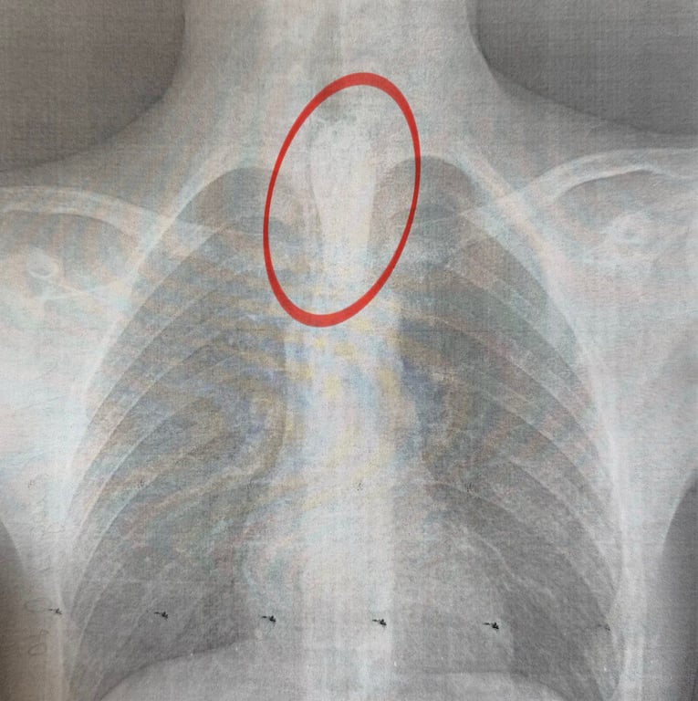 У Львові медики врятували хлопця, який подавився шашликом - фото 2