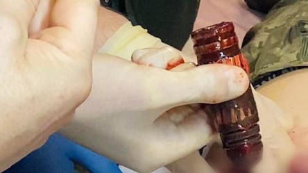 Українські медики витягли з тіла пораненого бійця гранату, яка не розірвалась - 285x160