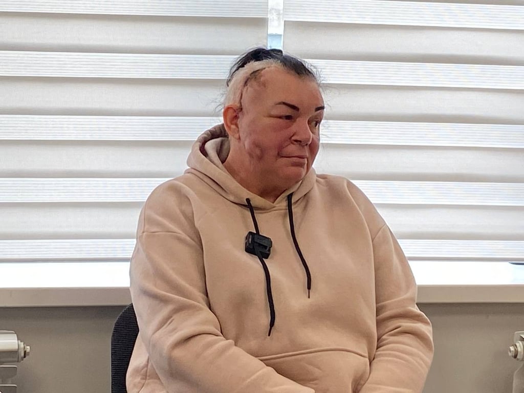 Обломки вражеской ракеты лишили лица - история женщины из Рубежного, которая учится улыбаться - фото 3