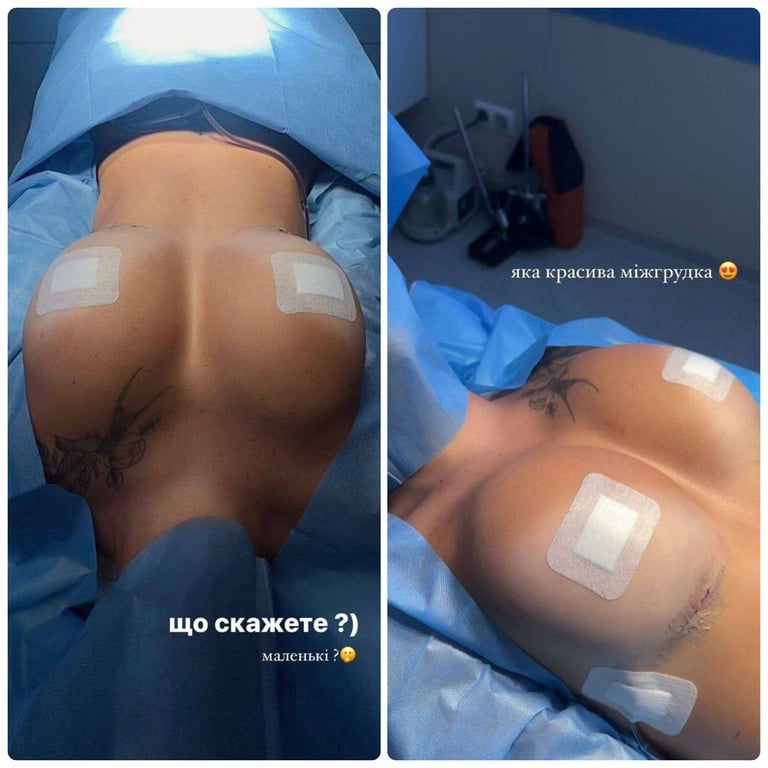 Ліна Сидор після збільшення грудей. Фото: telegram/linasydor