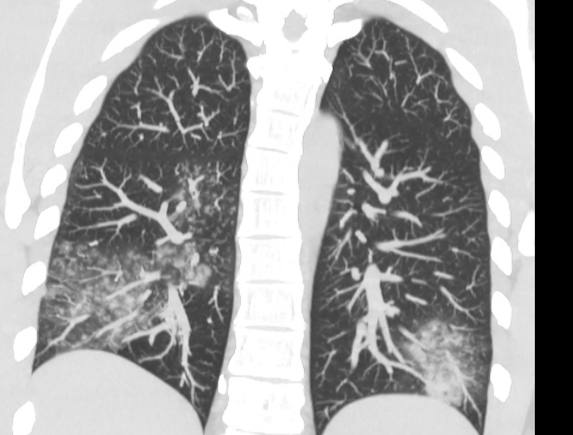 Снимок легких