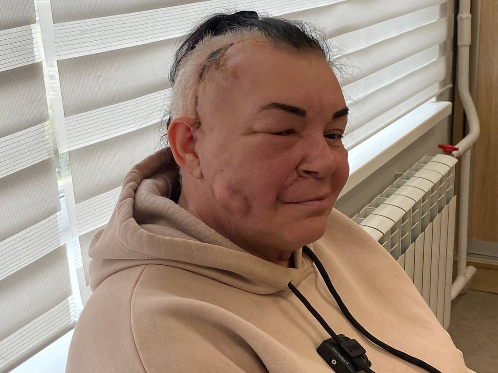 Обломки вражеской ракеты лишили лица – история женщины из Рубежного, которая учится улыбаться - фото 1