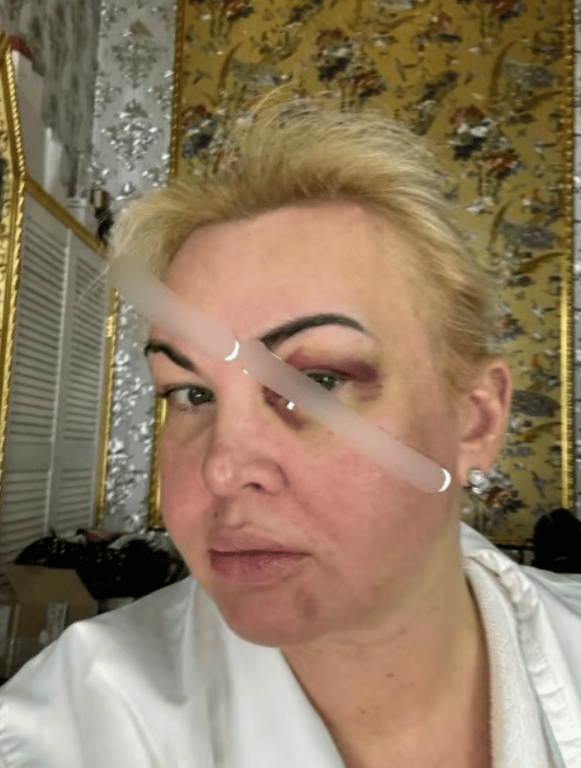 Камалия с синяками на лице