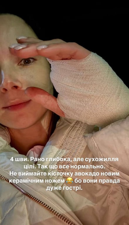 Дружина Тімура Мірошниченка травмувала руку - фото