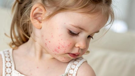 Вирус Коксаки — какие симптомы и как передается - 285x160