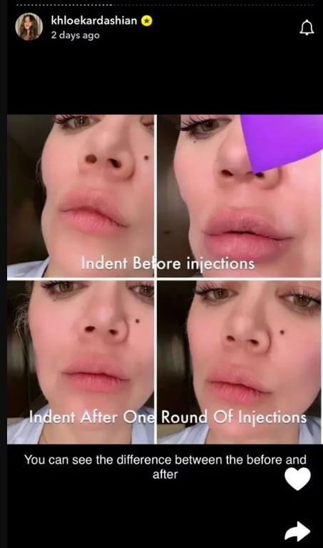 Хлої Кардаш'ян перенесла операцію 