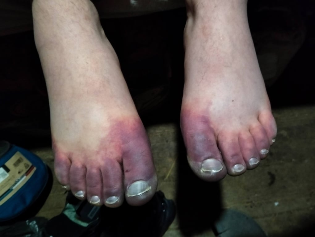 Обморожені ноги