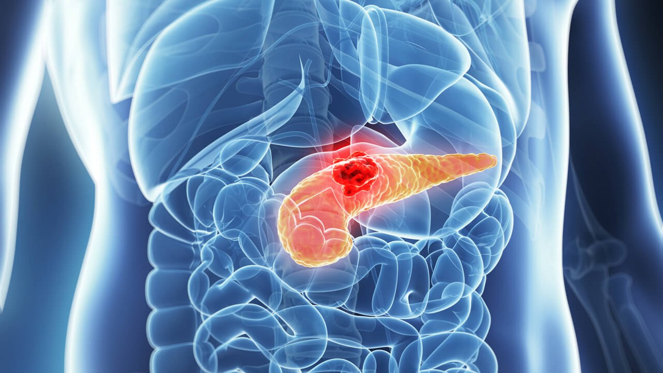 Ученые обнаружили главную причину рака поджелудочной железы