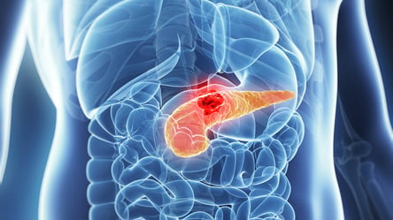Ученые обнаружили главную причину рака поджелудочной железы: детали исследования - 285x160