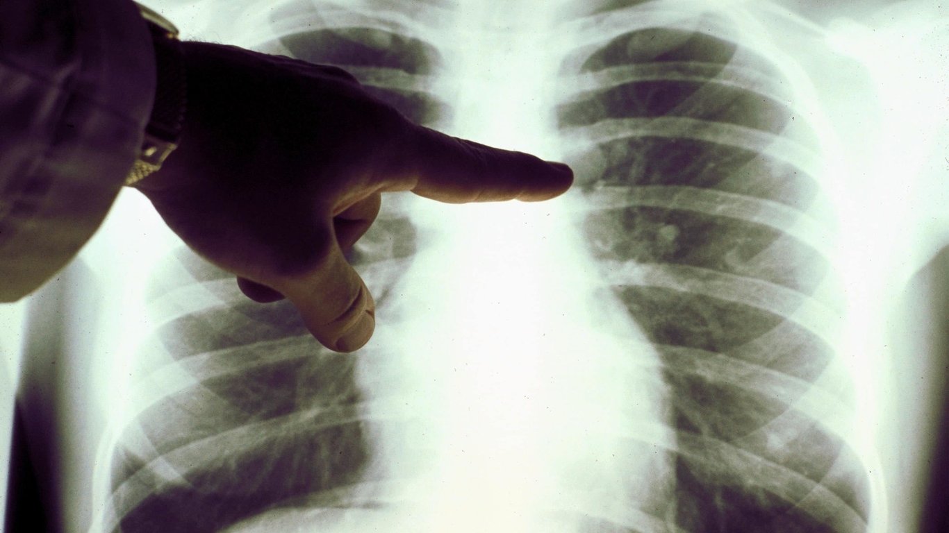 5 неочікуваних симптомів раку легень