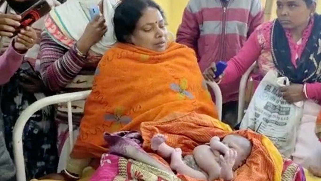 В Індії народилася дитина з чотирма руками і чотирма ногами