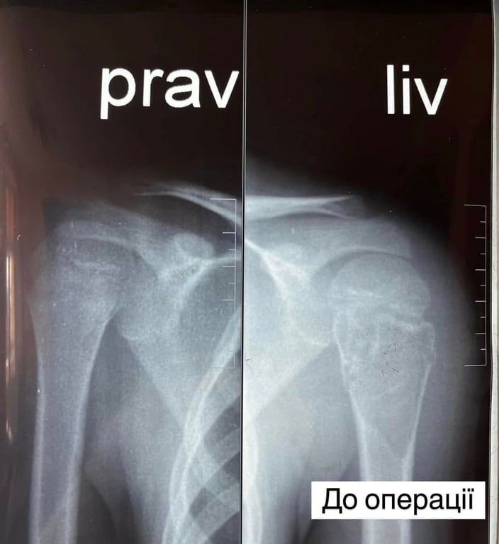 Аневризмальна кіста