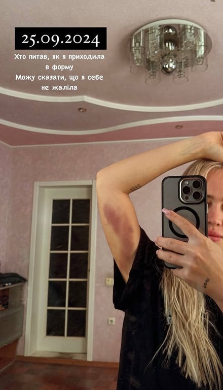 Инна Белень показала последствия интенсивных массажей