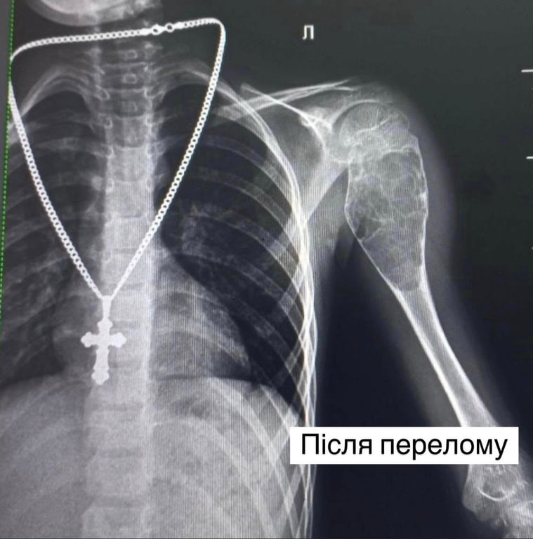 аневризмальна кіста плечової кістки