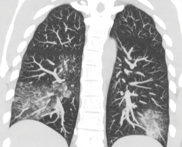 Метапневмовірус - що відомо