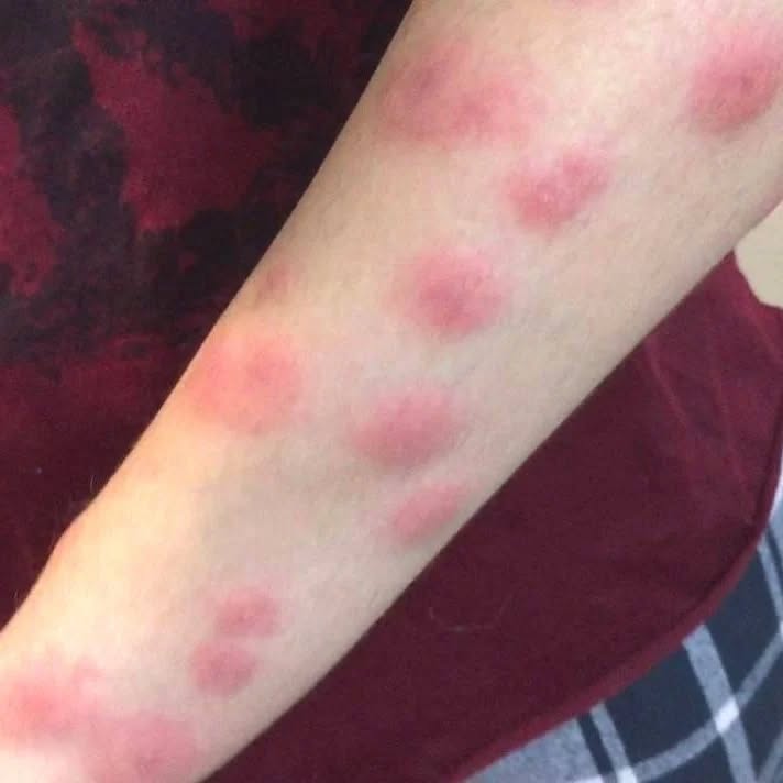 Укуси клопів