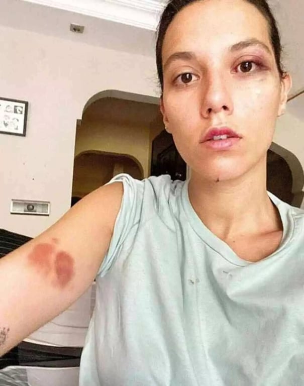 Деніз Булутсуз показала наслідки побиття Озаном Гювеном - фото