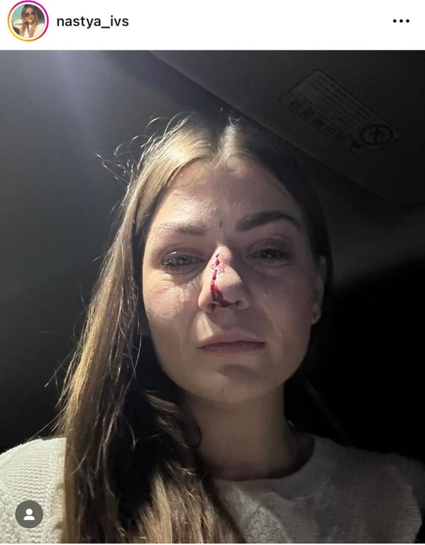 Сломанный нос у женщины в результате избиения