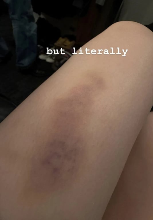 Билли Айлиш упала во время концерта