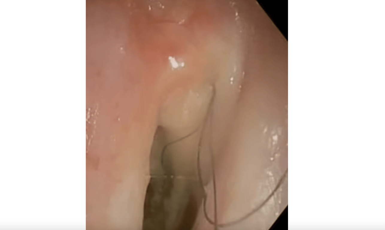 В горле 52-летнего курильщика, выкуривавшего по пачке сигарет в день, начали расти волосы