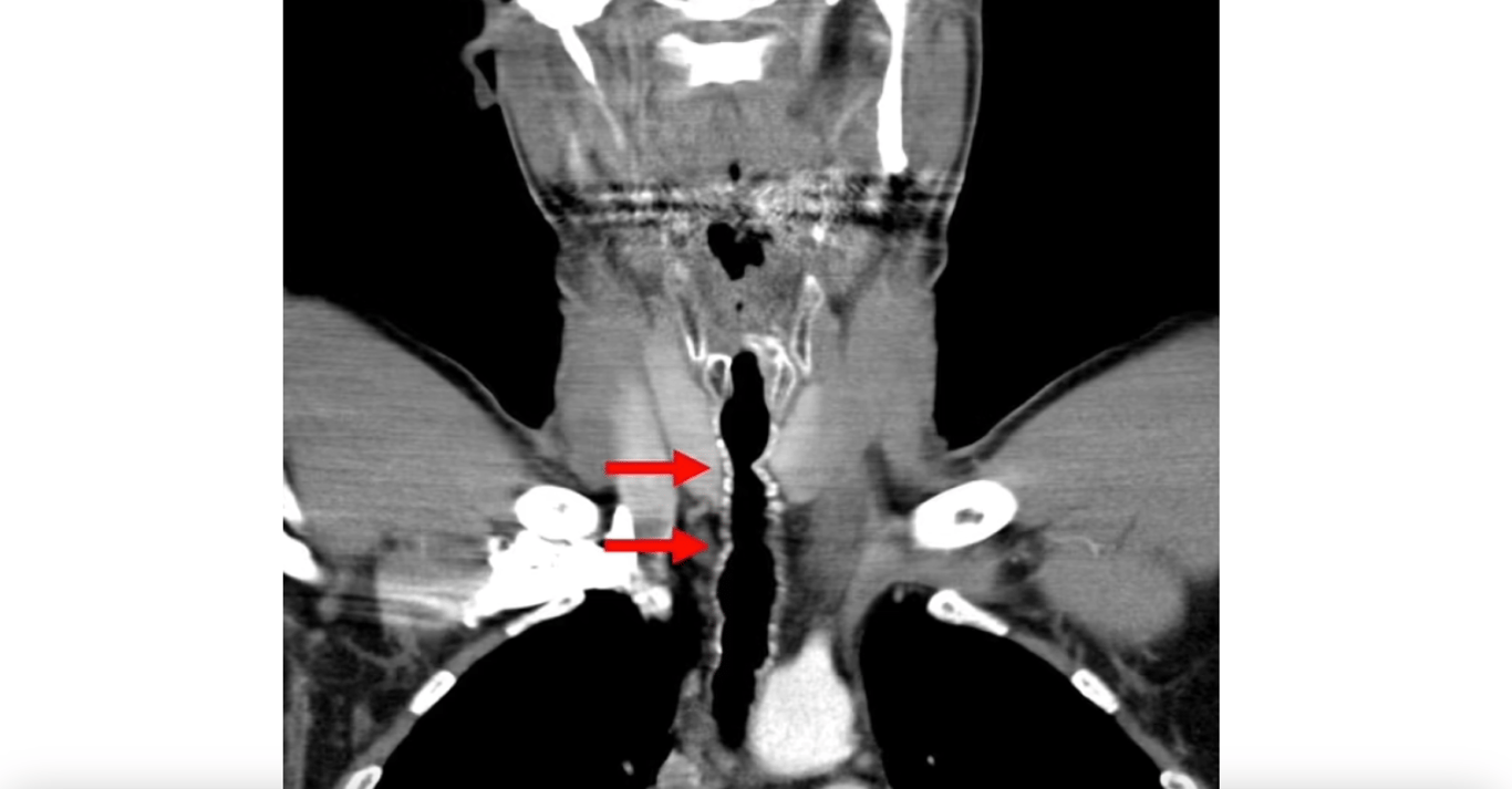 Волосы выросли в горле мужчины — врачи заявили, что причина в сигаретах