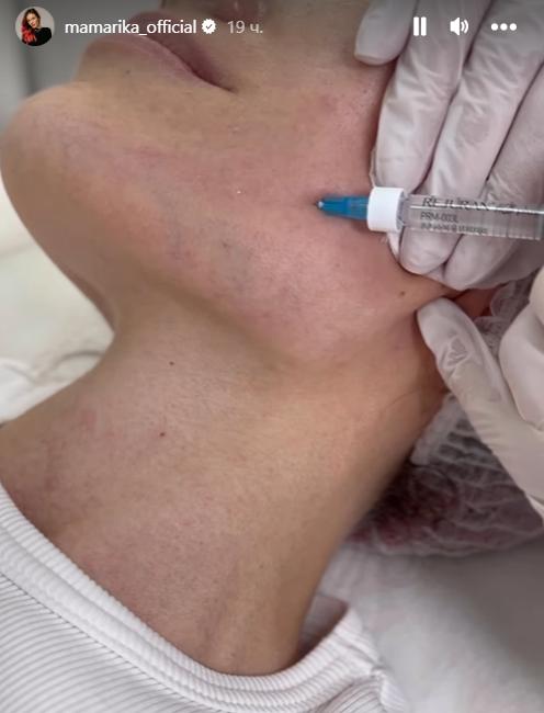 Співачка MamaRika під час процедури. Фото: instagram.com/mamarika_official/