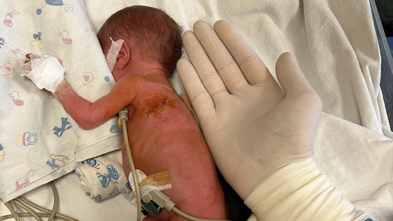 Одеські лікарі врятували недоношене немовля з вадою серця — деталі