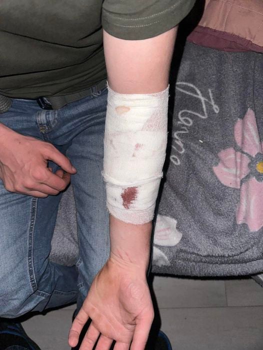 Рука чоловіка після інциденту. Фото: Duny Jeż Emreis/Facebook