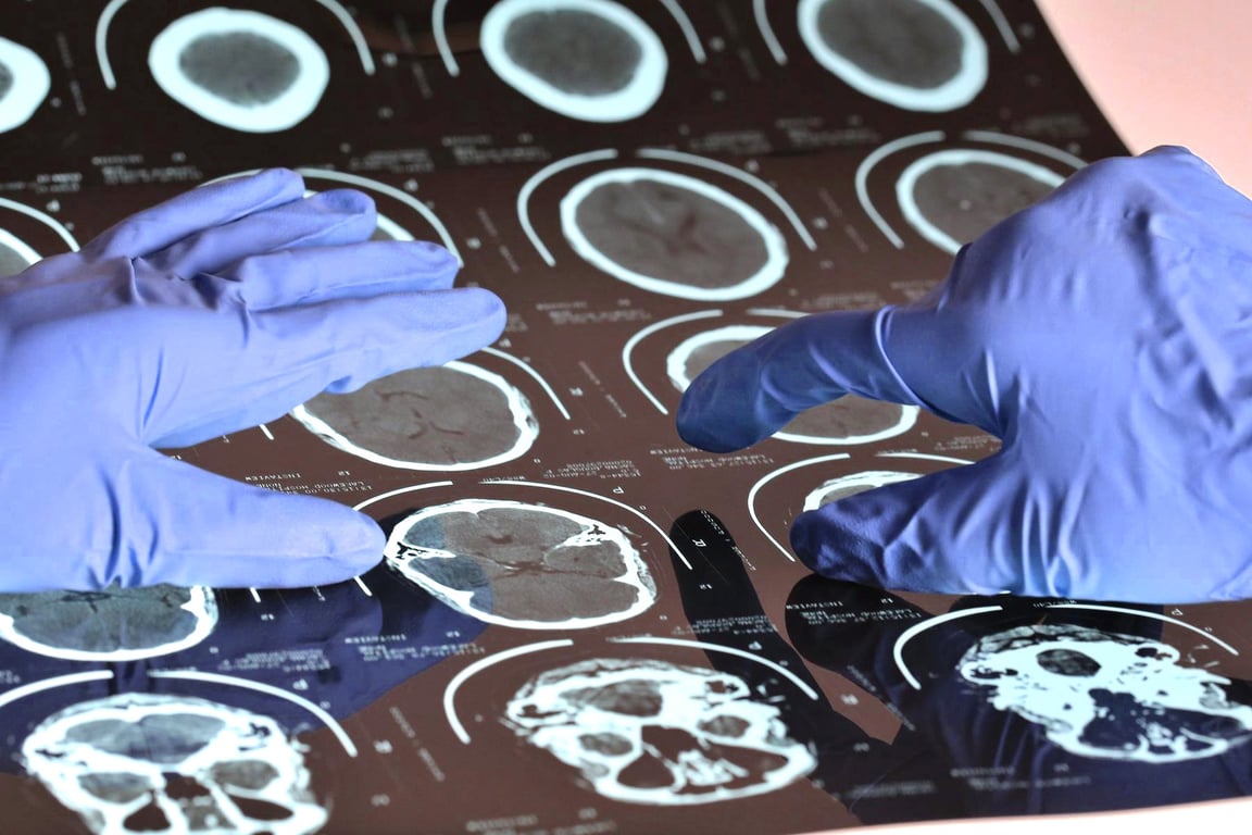 Хвороба, що руйнує мозок, виявилася заразною — що кажуть вчені, як захиститися