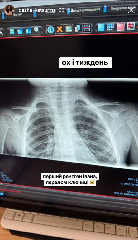 Рентген сина Даші Кацуріної