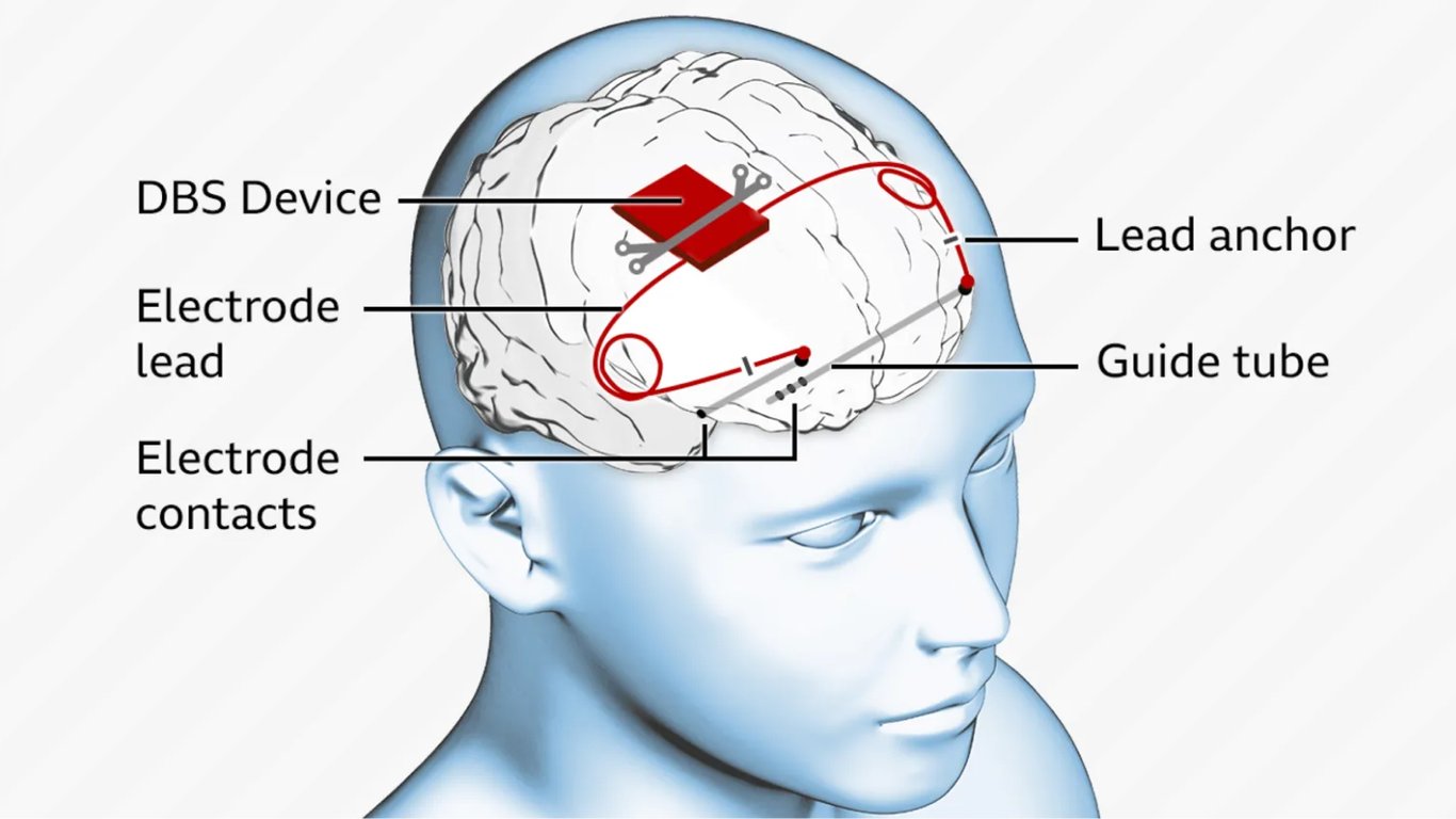 Хлопчику з Великобританії вперше в світі встановили мозковий імплант