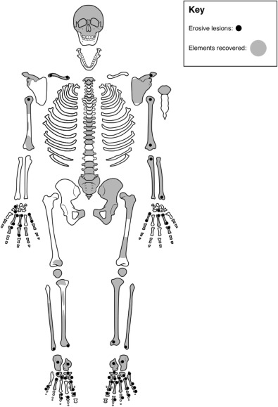В 3500-летнем скелете обнаружили страшную болезнь - что говорят ученые