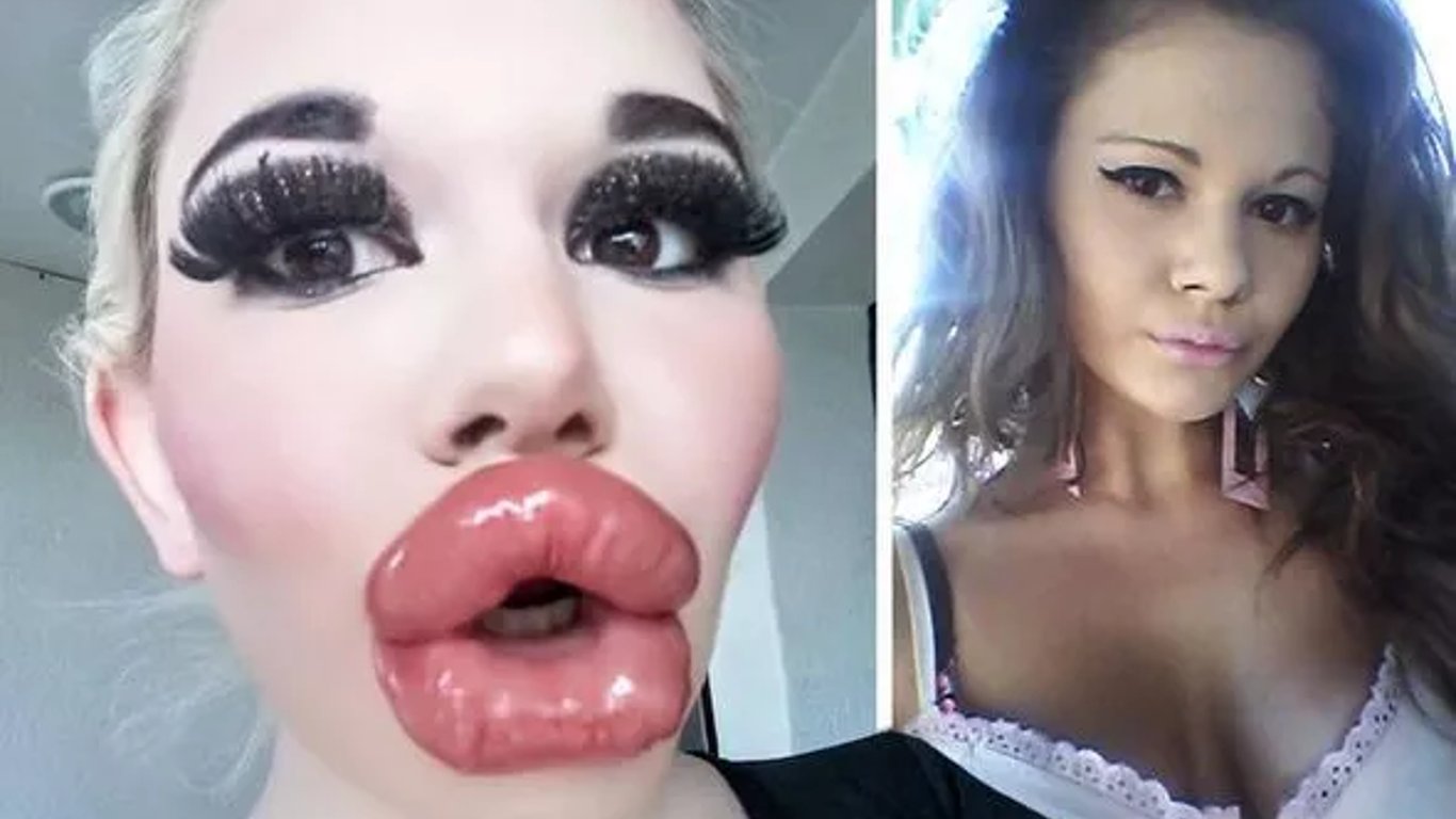 Як виглядає дівчина із найбільшими губами у світі після 26 ін'єкцій. Фото