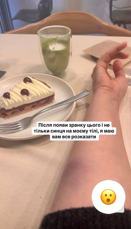 Оля Цибульська показала синці