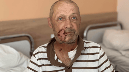 Во Львовской области собака напала на мужчину и вырвала ему кусок щеки - 285x160