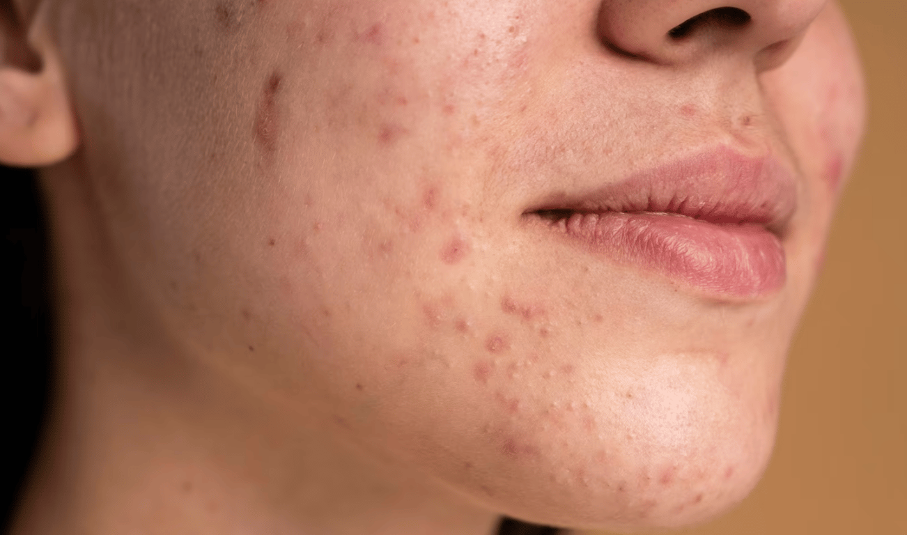 Прищи на лице, которые могут возникать из-за отсутствия вечернего душа