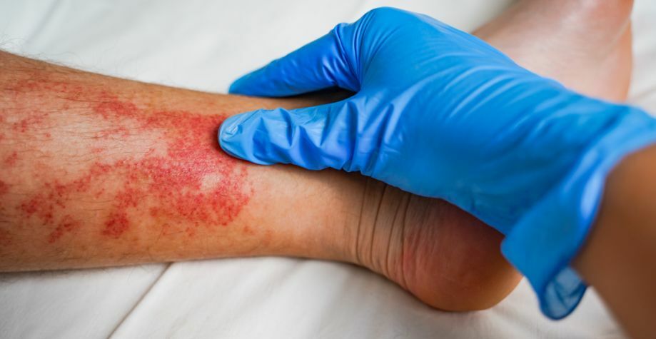 Атопическая экзема