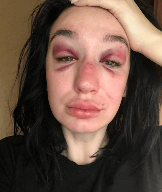 У Запоріжжі жорстоко побили дівчину біля бару - вона дістала численні травми