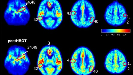 Израильские врачи узнали, как можно замедлить болезнь Альцгеймера - 285x160