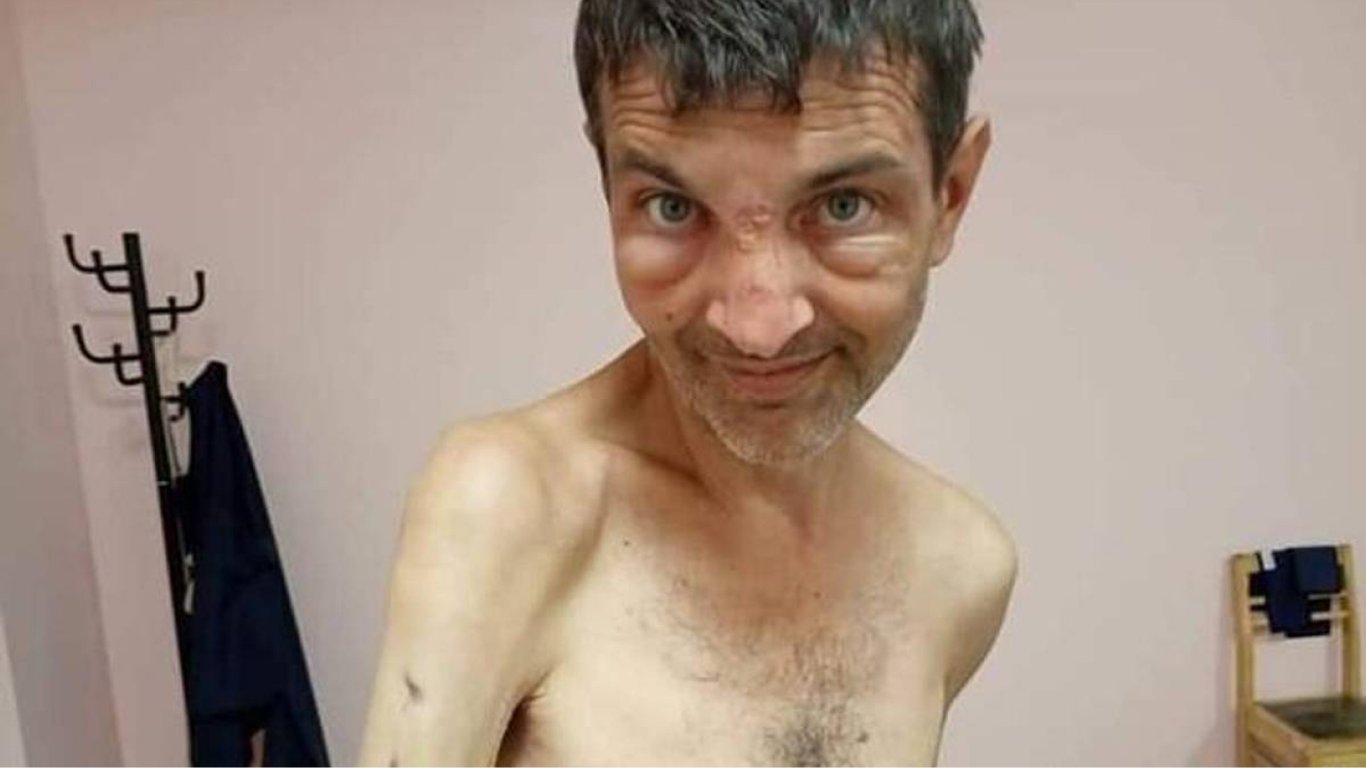 Из-за пыток голодом 80% украинских пленных находятся в состоянии анорексии