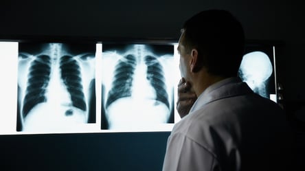 6 популярних міфів про рак легень - 285x160