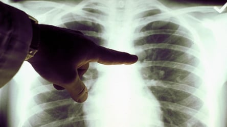 Чому рак легенів буває у тих, хто не палить: учені дали відповідь - 285x160