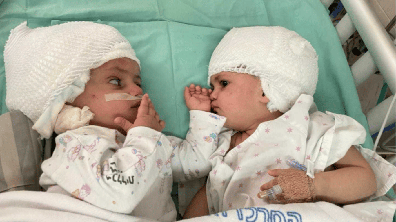 В Израиле провели уникальную операцию по разделению сиамских близнецов